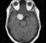 Can You See Brain Tumor on Mri Without Contrast?