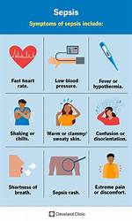 Does Sepsis Cause Sweating?