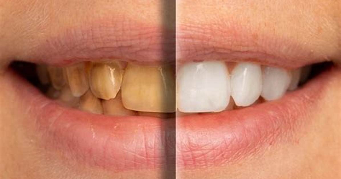Will Yellow Teeth Ever Become White?
